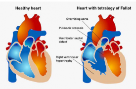 以前未知的蛋白质在先天性心脏畸形中发挥着关键作用
