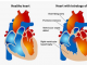 以前未知的蛋白质在先天性心脏畸形中发挥着关键作用